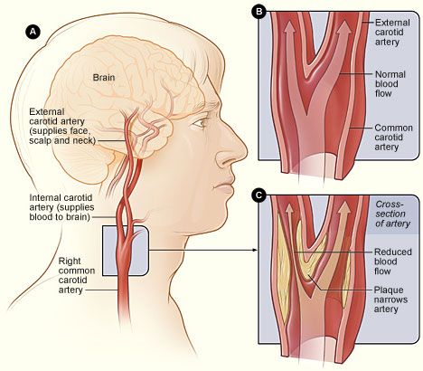Carotid Arteries Graphic