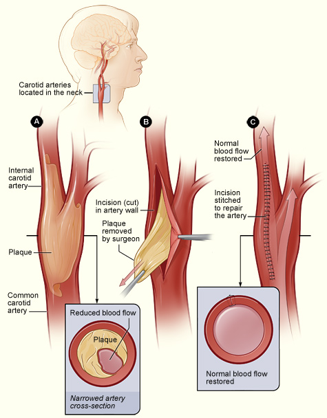 Carotid Artery Endarterectomy