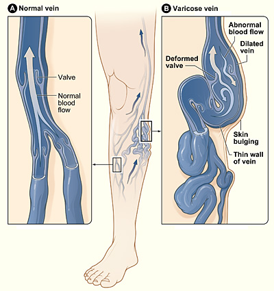 SCLEROTHERAPY- A MEDICAL PROCEDURE TO ELIMINATE VARICOSITIES AND ABNORMAL  VEINS
