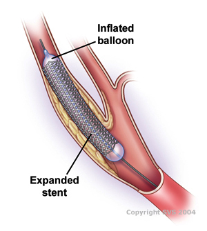 carotid stent