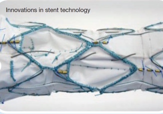 Innovations In Stent Technology
