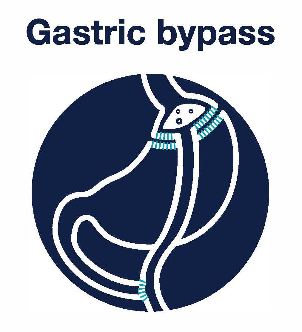 Gastric Bypass